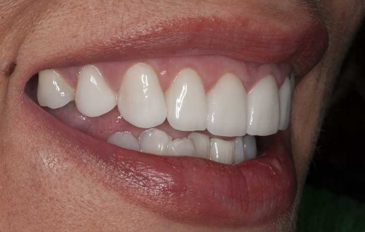 case 1 smile makeover after White House, TN