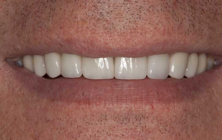 case 2 smile makeover after White House, TN
