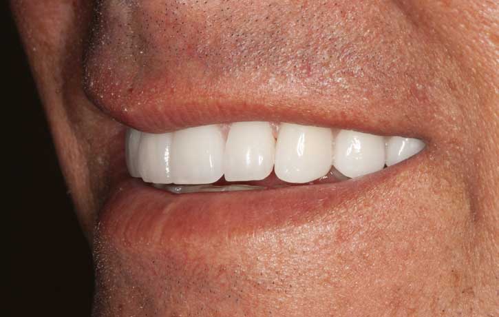 case 4 smile makeover after White House, TN