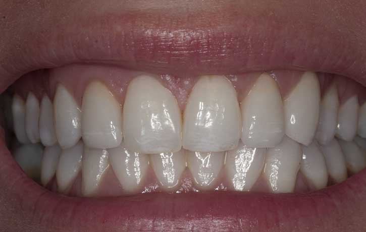 case 5 smile makeover after White House, TN