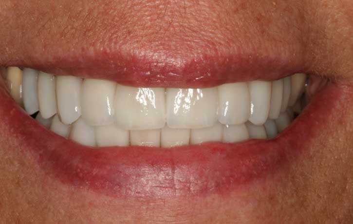 case 6 smile makeover after White House, TN