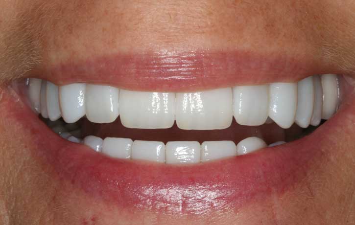case 7 smile makeover after White House, TN