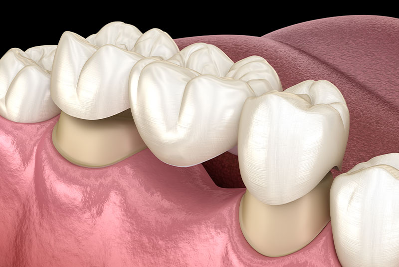 bridge cerec 3d