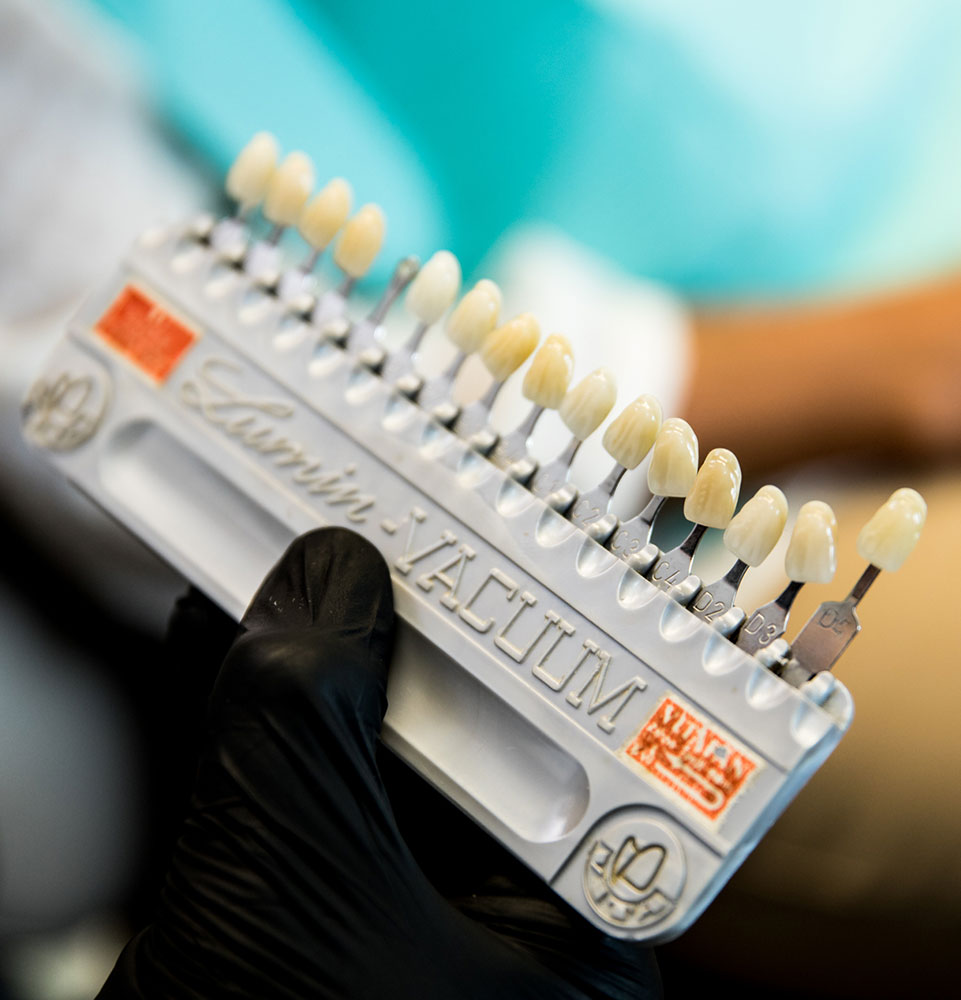 veneer options dr givens