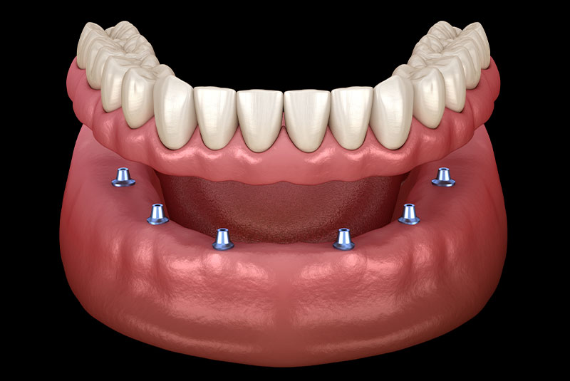 implant-supported-dentures